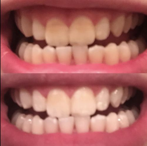 Advanced Teeth Whitening Strips photo review