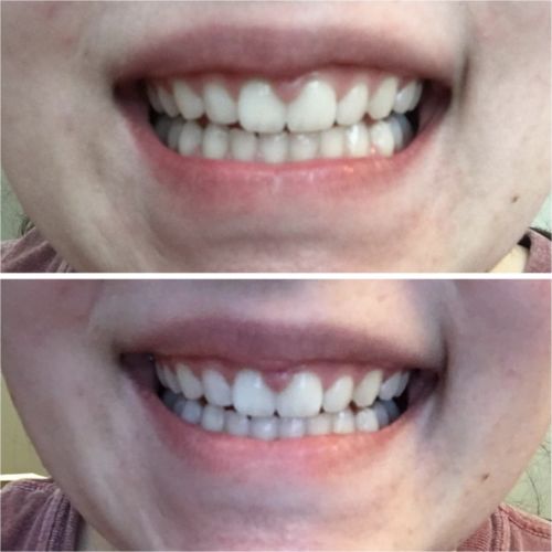 Advanced Teeth Whitening Strips photo review