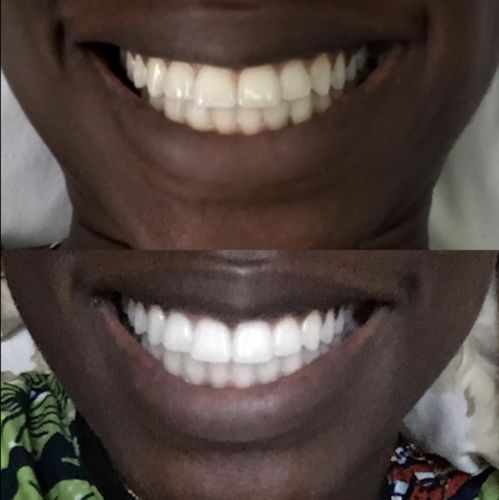 Advanced Teeth Whitening Strips photo review