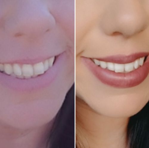 Advanced Teeth Whitening Strips photo review