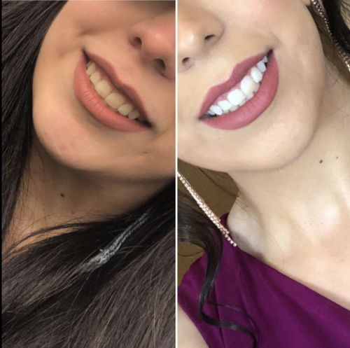 Advanced Teeth Whitening Strips photo review