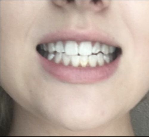 Advanced Teeth Whitening Strips photo review