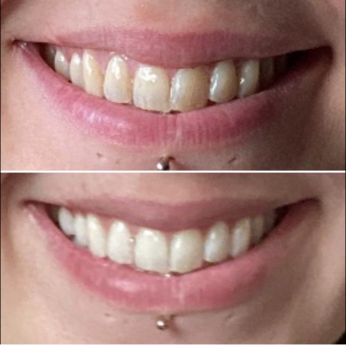 Advanced Teeth Whitening Strips photo review