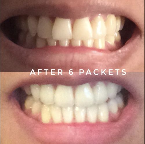 Advanced Teeth Whitening Strips photo review