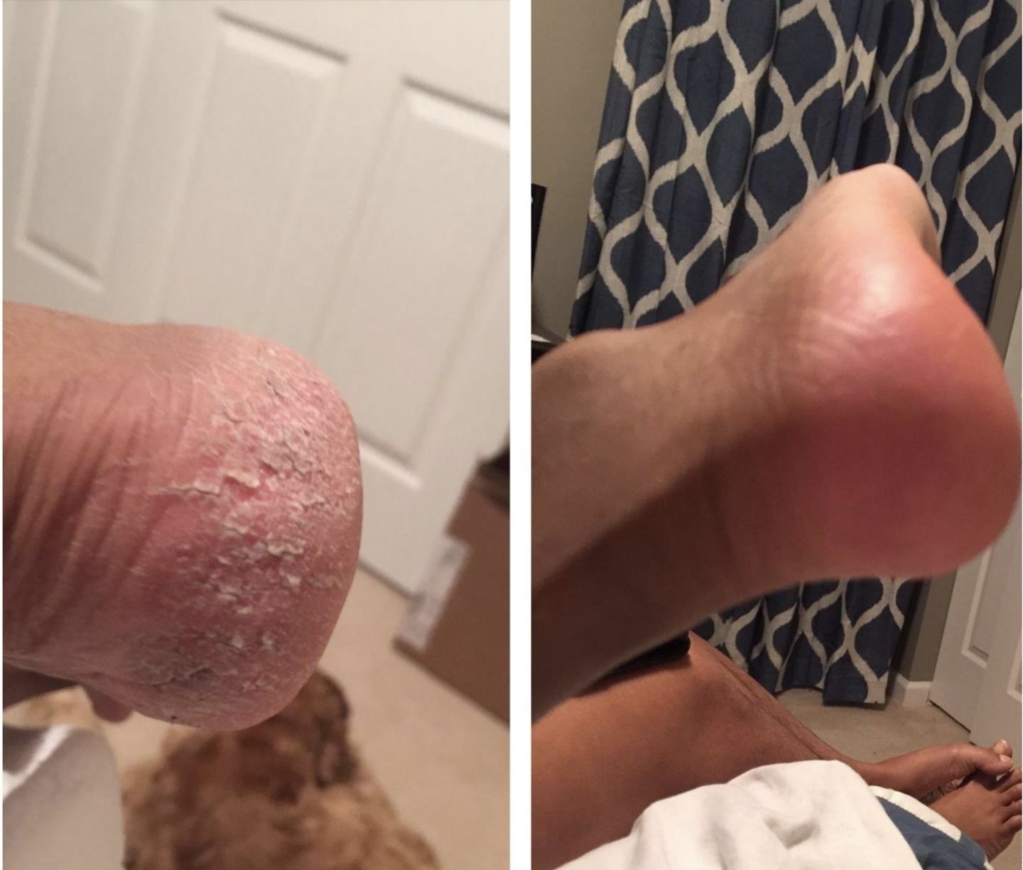Callus Removal photo review