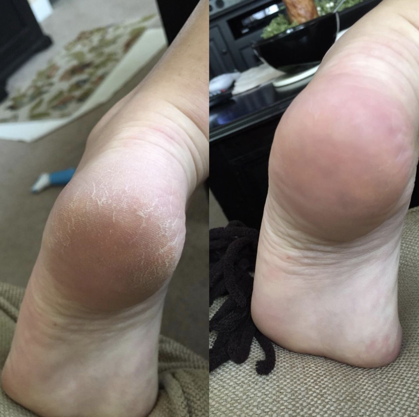 Callus Removal photo review