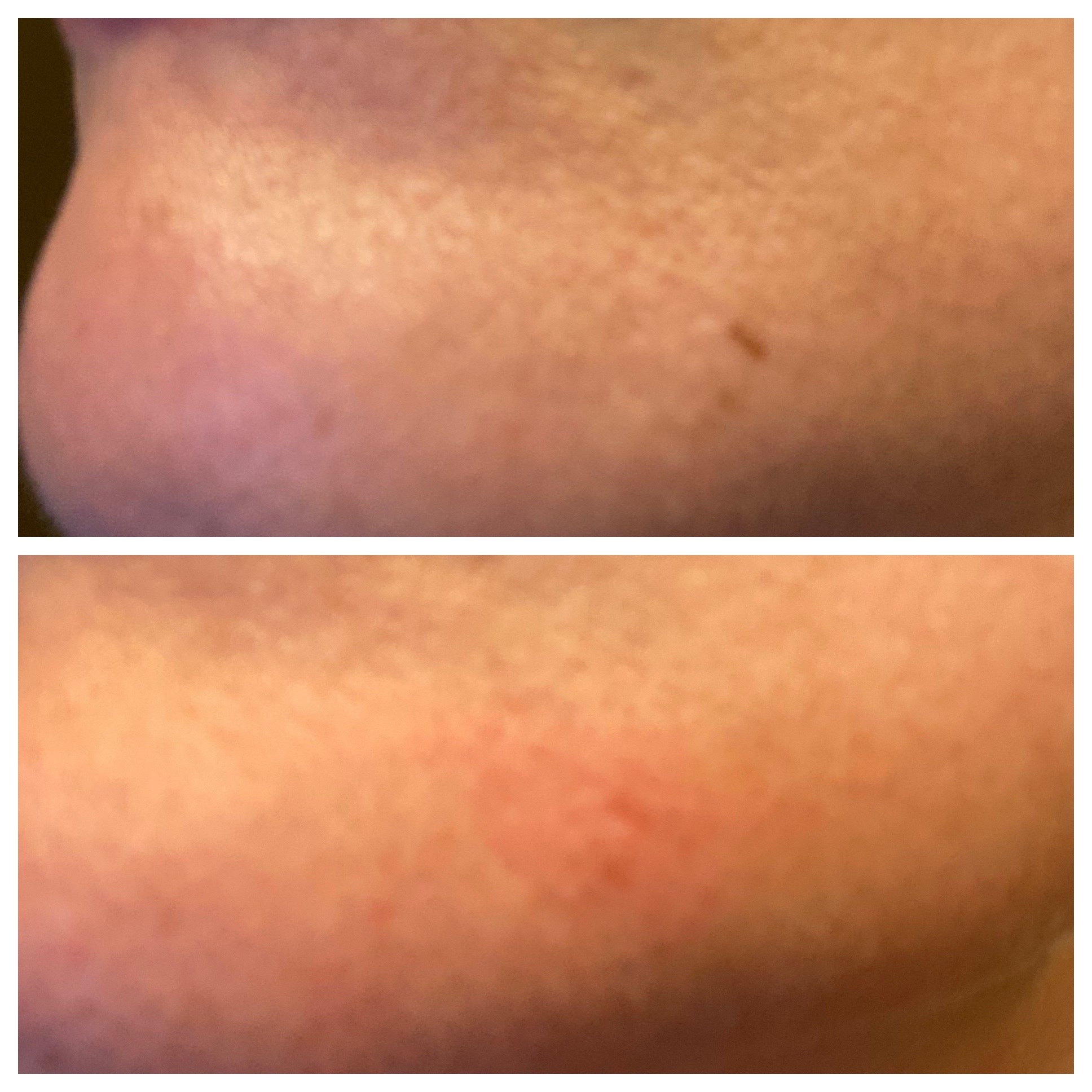 Laser Permanent Tattoo Removal At Home photo review