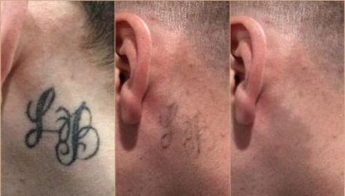 Laser Permanent Tattoo Removal At Home photo review