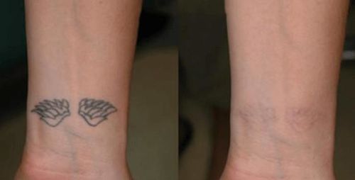 Laser Permanent Tattoo Removal At Home photo review