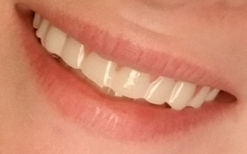 Snap On Dentures Perfect Smile photo review