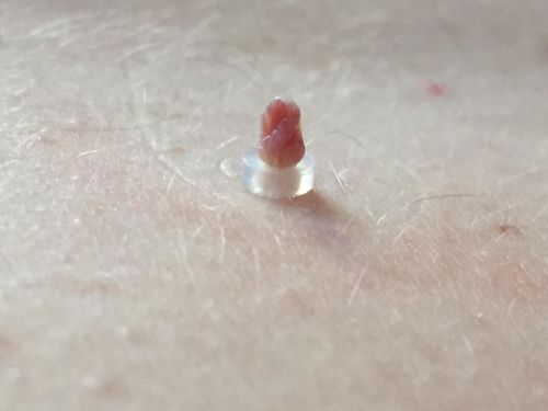 Skin Tag Removal Kit photo review