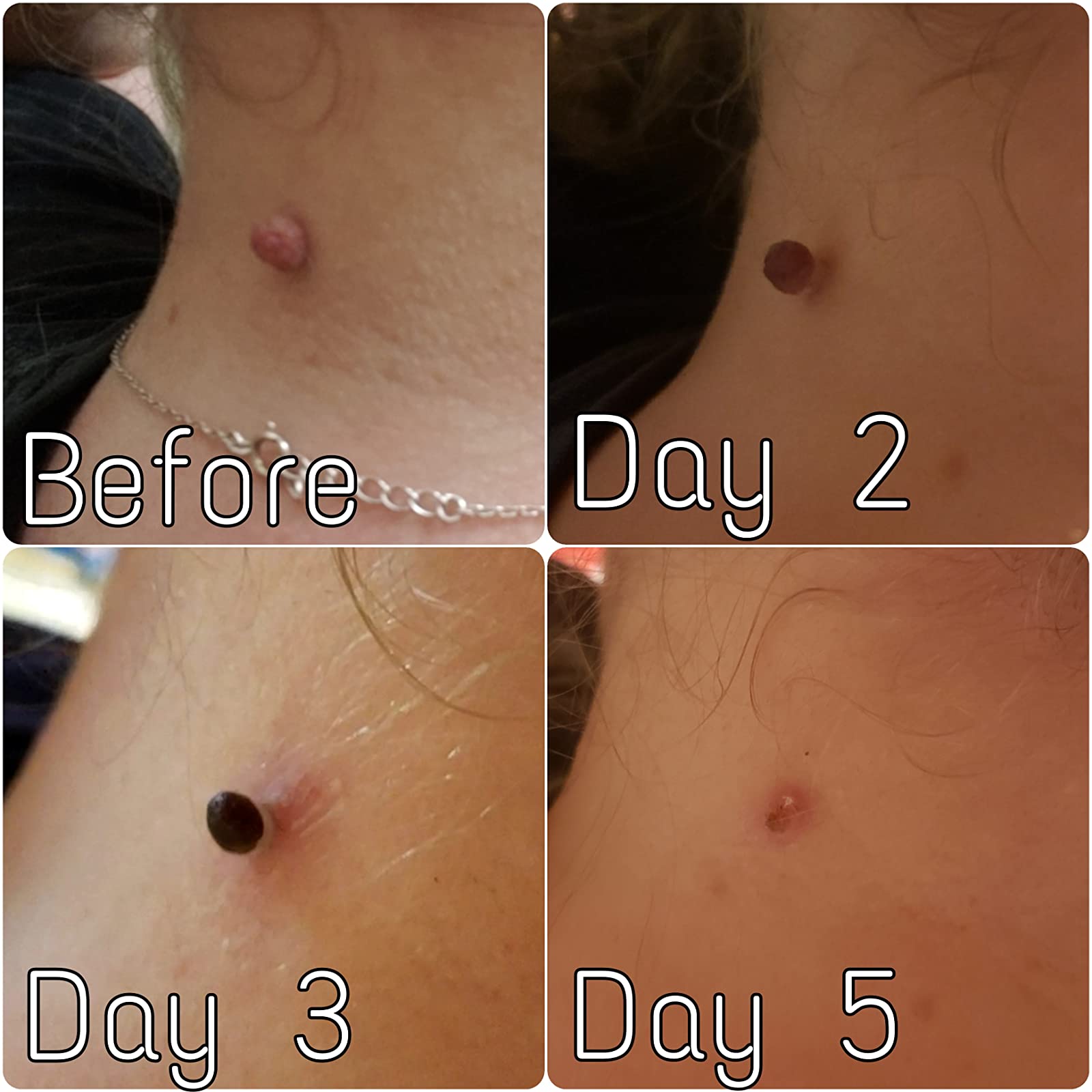 Skin Tag Removal Kit photo review