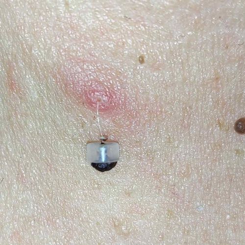 Skin Tag Removal Kit photo review